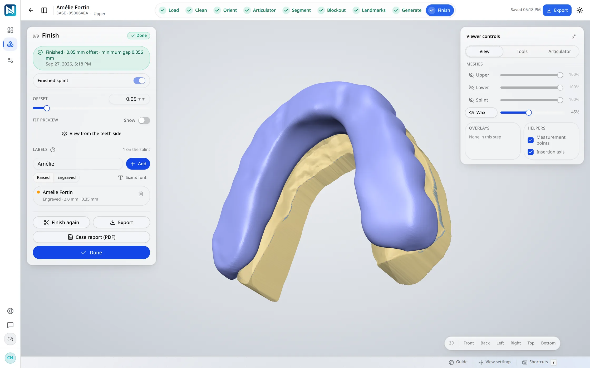 The NexorCAD designer with a finished upper splint on the scanned arch, seen from below, and the nine steps across the top, all complete.