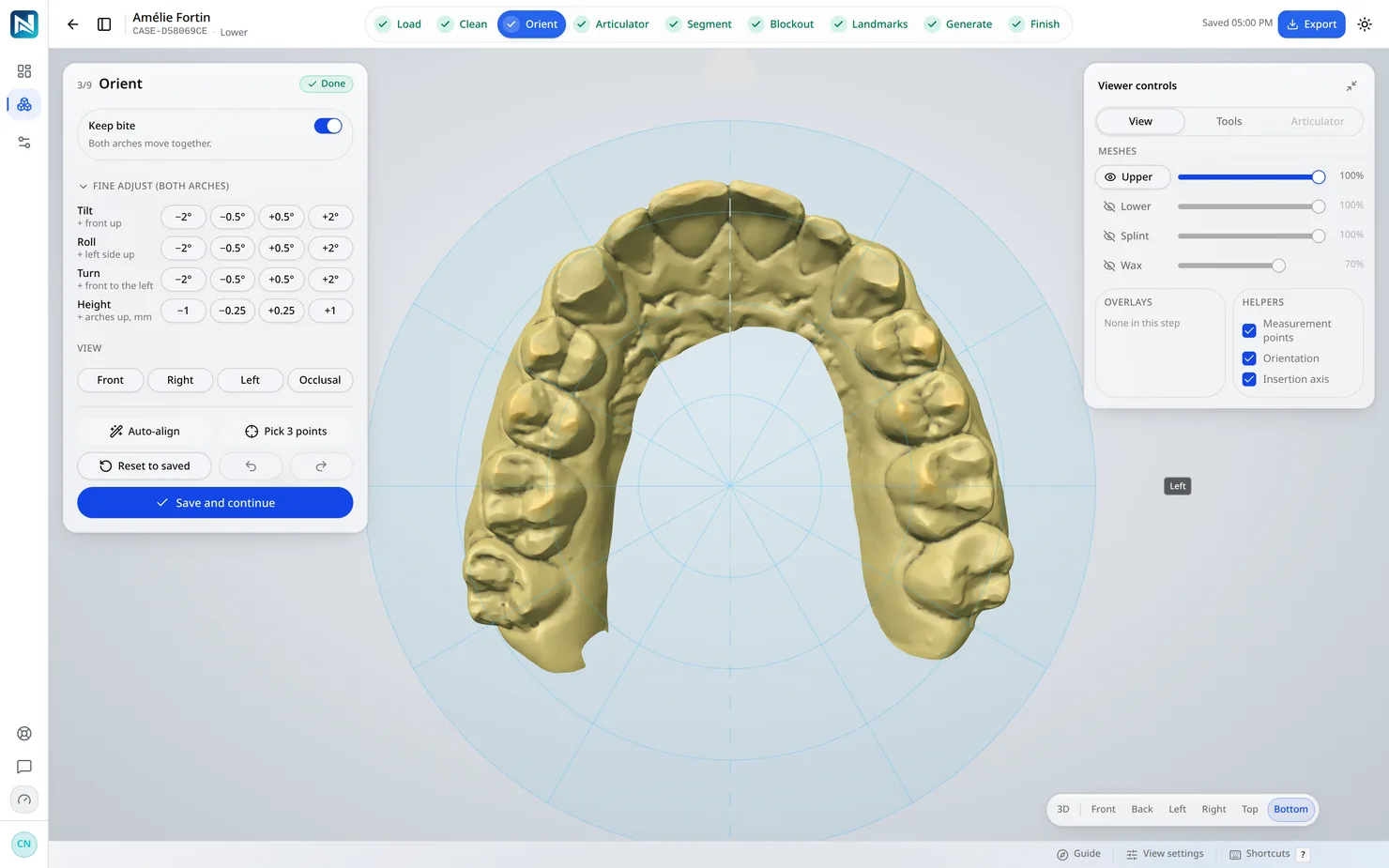 Orient — The arch is set on the occlusal plane. Everything after this measures against that, which is why it happens early.