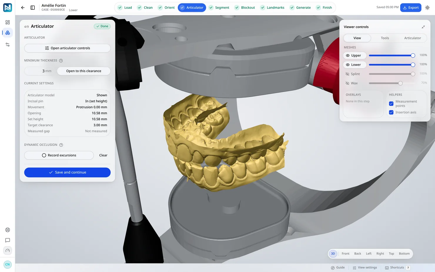 Articulator — The two arches are brought into occlusion and the bite is fixed, so the table is built against a real antagonist.