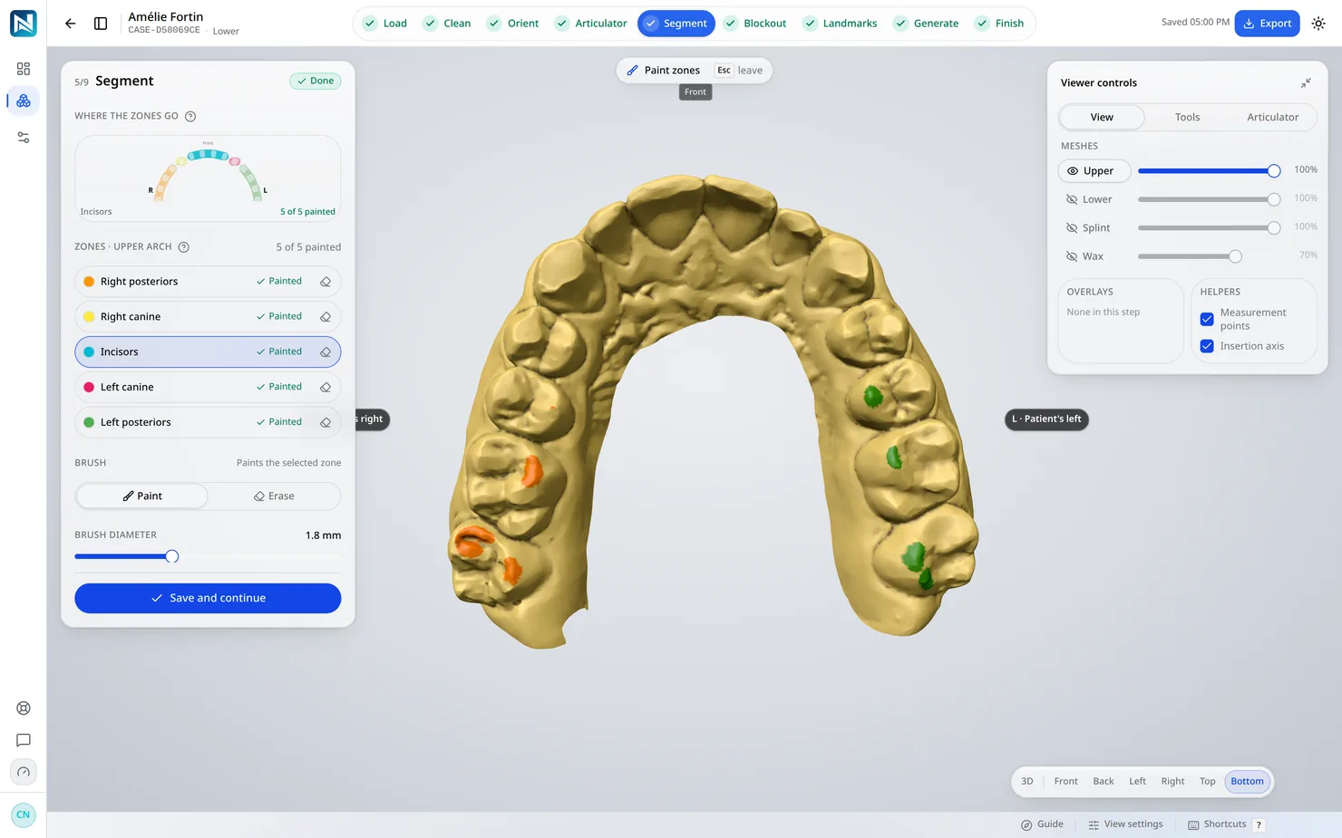 Segment — Teeth are separated from gingiva. The splint has to know what it sits on before it can decide where to grip.