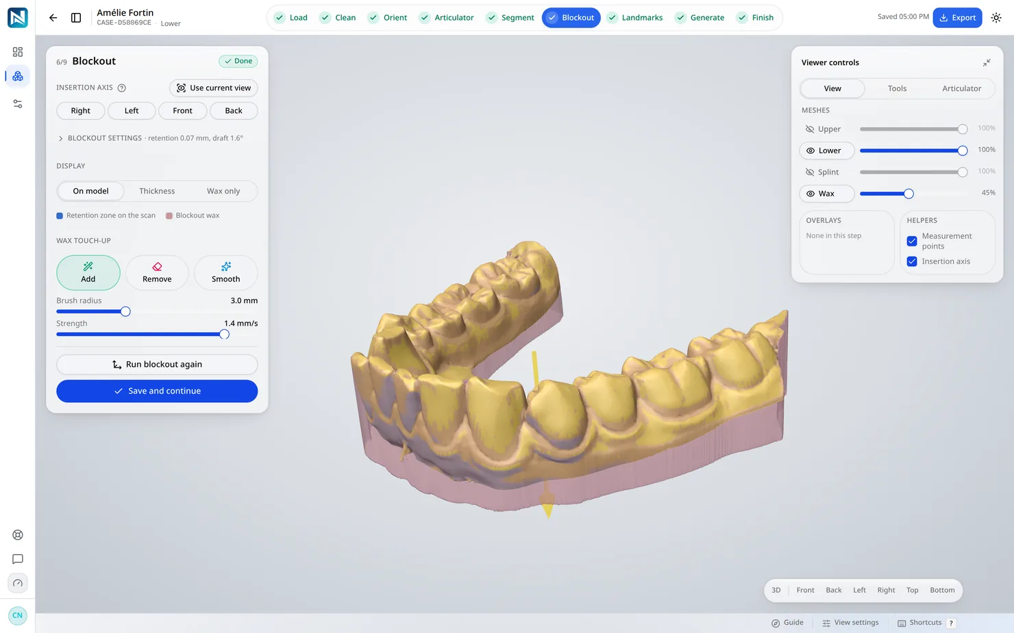 Blockout — Undercuts are shown on the scan, then filled with wax along the insertion axis. You choose what holds and what lets go.