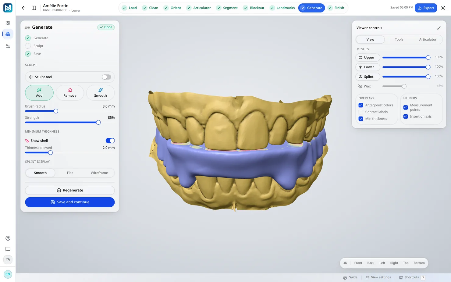 Generate — The shell is built over the blockout in one pass: coverage, wall height, thickness and the flat occlusal table.