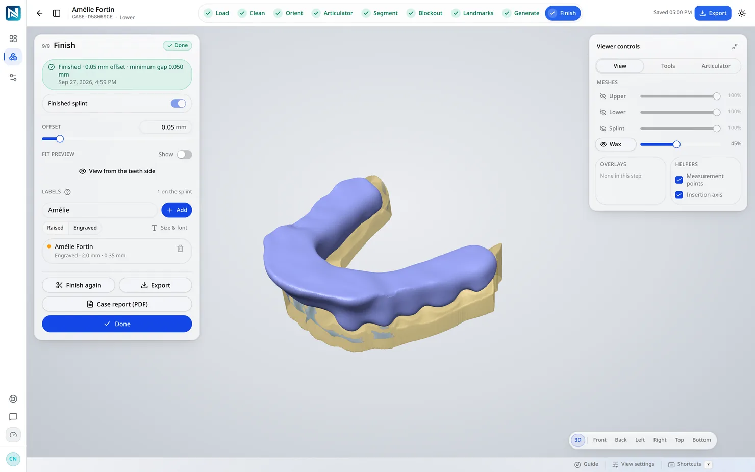 Finish — The wax is cut away, the fitting surface is relieved, the case is written into the mesh, and the STL is ready for the printer.